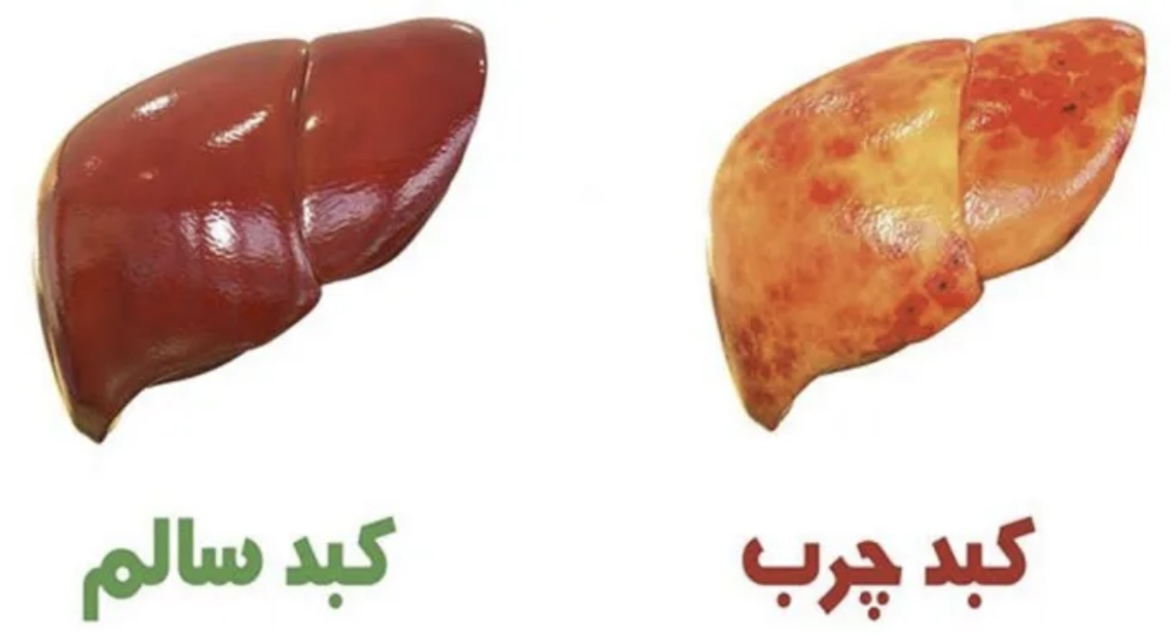 کبدچرب‌چیست؟ | بررسی عوارض ، تشخیص ، درمان و علائم کبد چرب